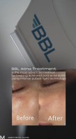 BBL Acne Protocols