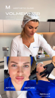 Volnewmer Face. Before/After