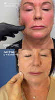 Endolift® face lifting by Dr. Milena
