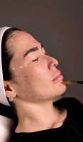 PRP procedure